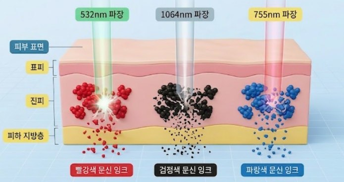 문신제거 후 흉터, 왜 생기는 걸까요? 관련 해부 구조 그림